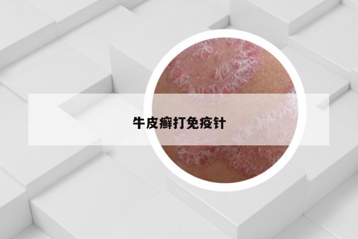 牛皮癣打免疫针