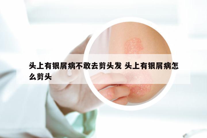 头上有银屑病不敢去剪头发 头上有银屑病怎么剪头