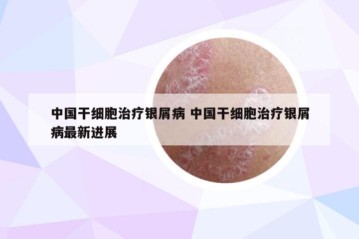 中国干细胞治疗银屑病 中国干细胞治疗银屑病最新进展