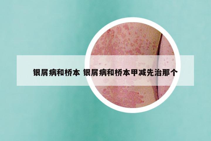 银屑病和桥本 银屑病和桥本甲减先治那个