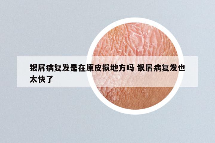 银屑病复发是在原皮损地方吗 银屑病复发也太快了