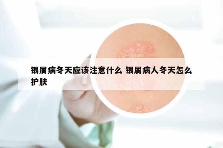 银屑病冬天应该注意什么 银屑病人冬天怎么护肤