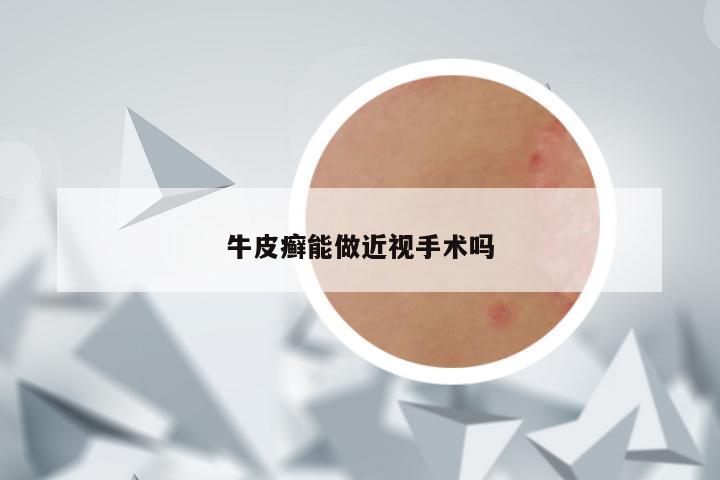牛皮癣能做近视手术吗