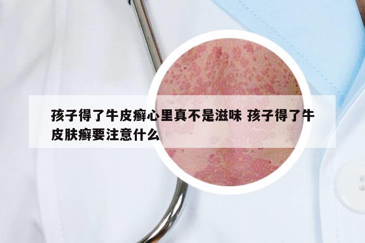 孩子得了牛皮癣心里真不是滋味 孩子得了牛皮肤癣要注意什么