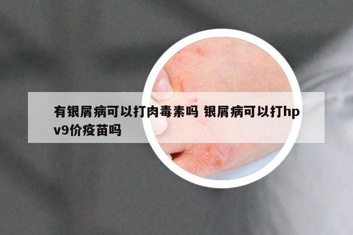有银屑病可以打肉毒素吗 银屑病可以打hpv9价疫苗吗