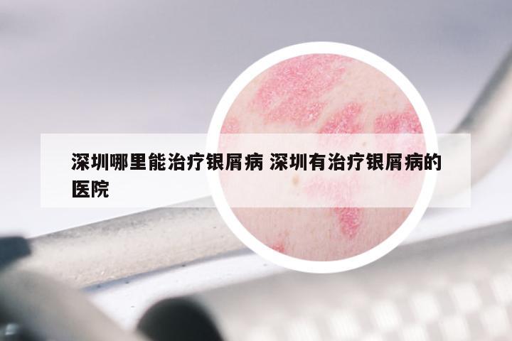 深圳哪里能治疗银屑病 深圳有治疗银屑病的医院