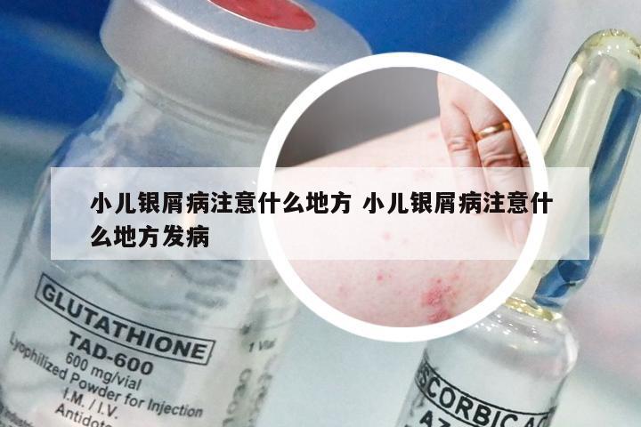小儿银屑病注意什么地方 小儿银屑病注意什么地方发病