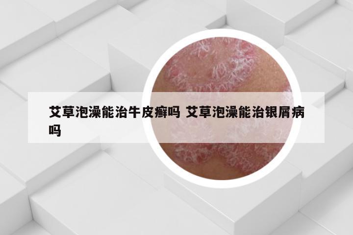 艾草泡澡能治牛皮癣吗 艾草泡澡能治银屑病吗