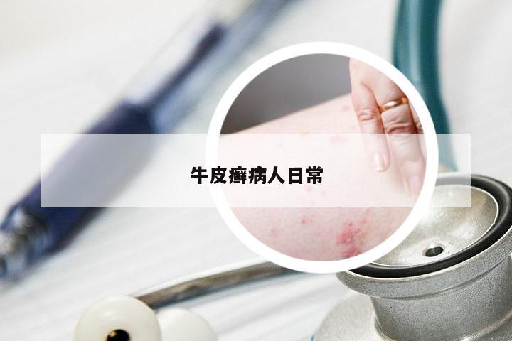 牛皮癣病人日常