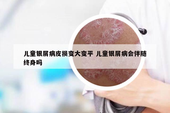 儿童银屑病皮损变大变平 儿童银屑病会伴随终身吗