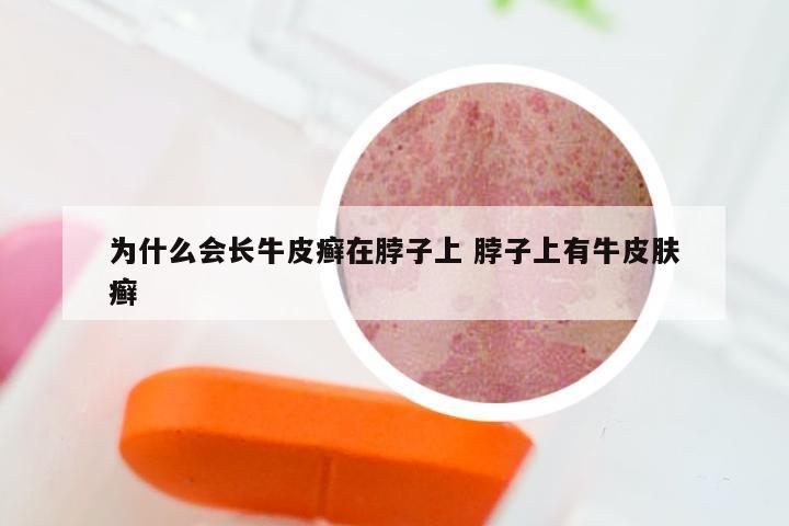 为什么会长牛皮癣在脖子上 脖子上有牛皮肤癣