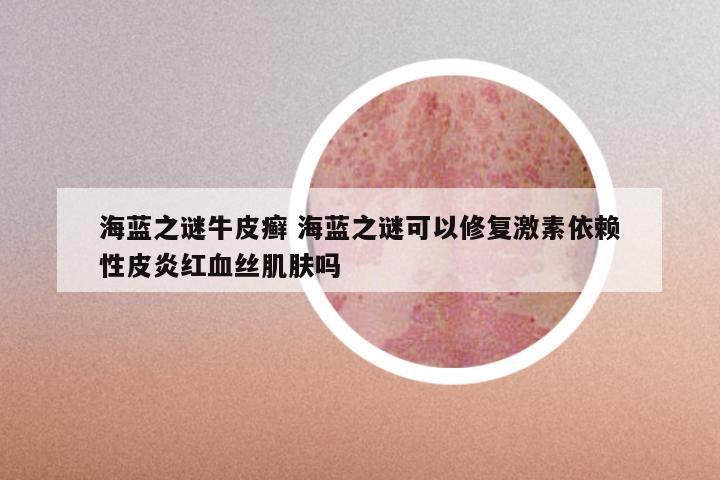 海蓝之谜牛皮癣 海蓝之谜可以修复激素依赖性皮炎红血丝肌肤吗