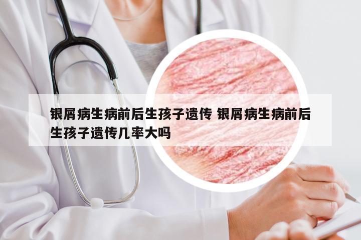 银屑病生病前后生孩子遗传 银屑病生病前后生孩子遗传几率大吗