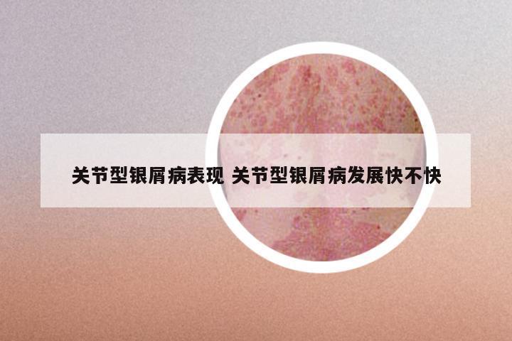 关节型银屑病表现 关节型银屑病发展快不快