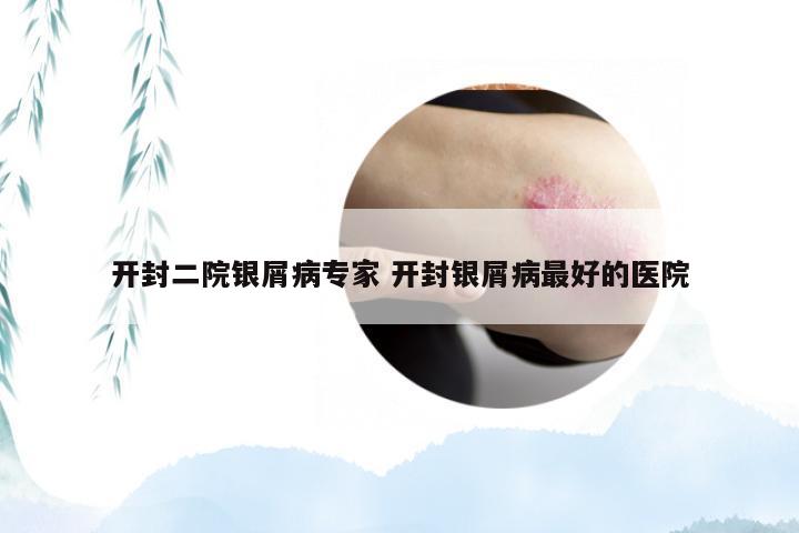 开封二院银屑病专家 开封银屑病最好的医院