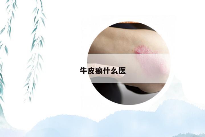 牛皮癣什么医