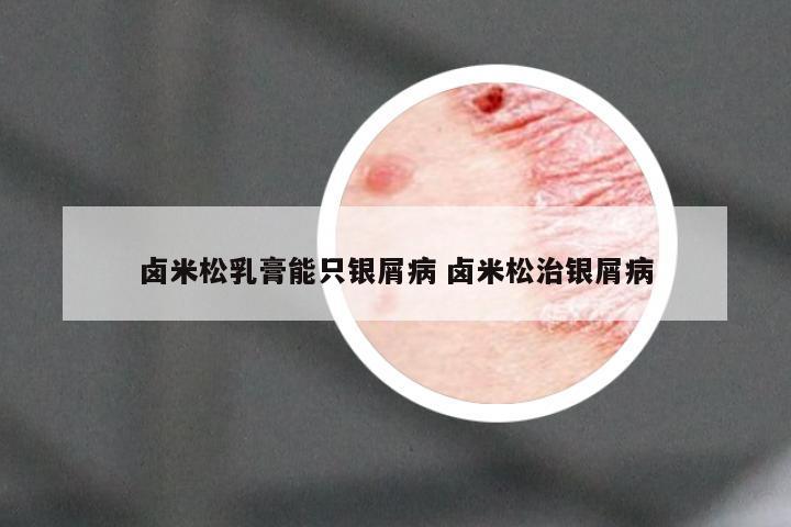 卤米松乳膏能只银屑病 卤米松治银屑病