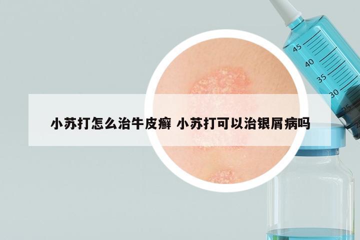 小苏打怎么治牛皮癣 小苏打可以治银屑病吗
