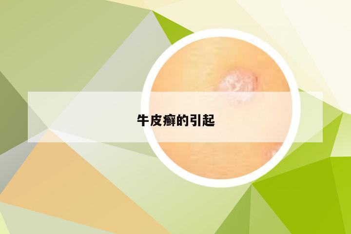 牛皮癣的引起
