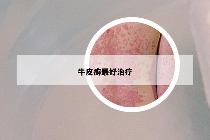 牛皮癣最好治疗