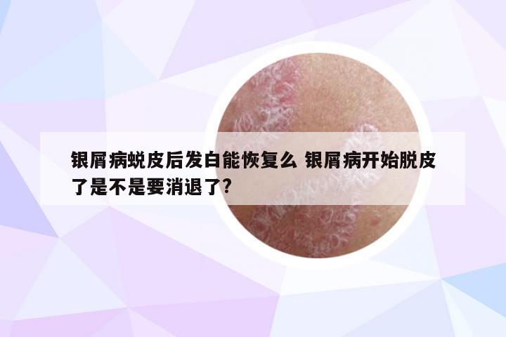 银屑病蜕皮后发白能恢复么 银屑病开始脱皮了是不是要消退了?