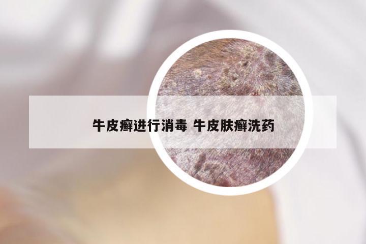 牛皮癣进行消毒 牛皮肤癣洗药