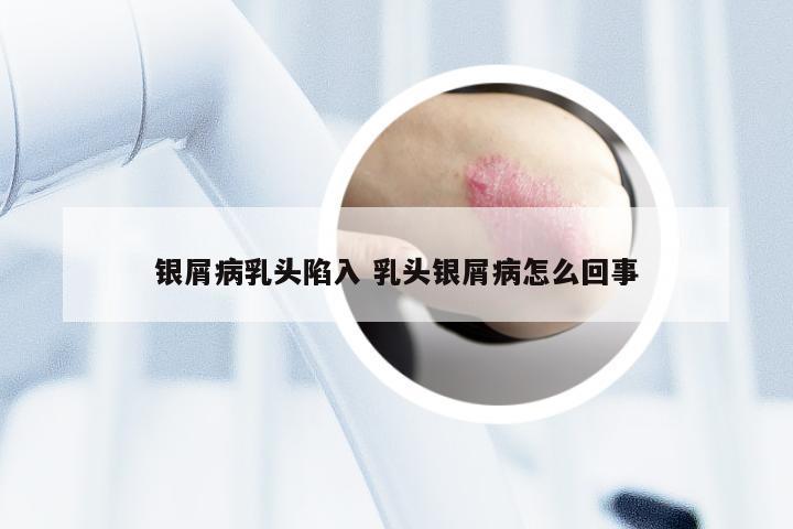 银屑病乳头陷入 乳头银屑病怎么回事