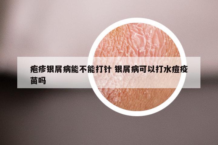 疱疹银屑病能不能打针 银屑病可以打水痘疫苗吗