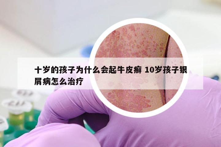 十岁的孩子为什么会起牛皮癣 10岁孩子银屑病怎么治疗