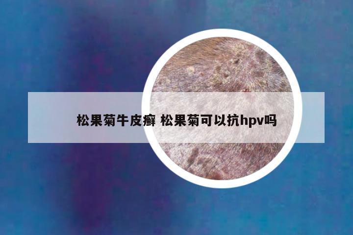 松果菊牛皮癣 松果菊可以抗hpv吗