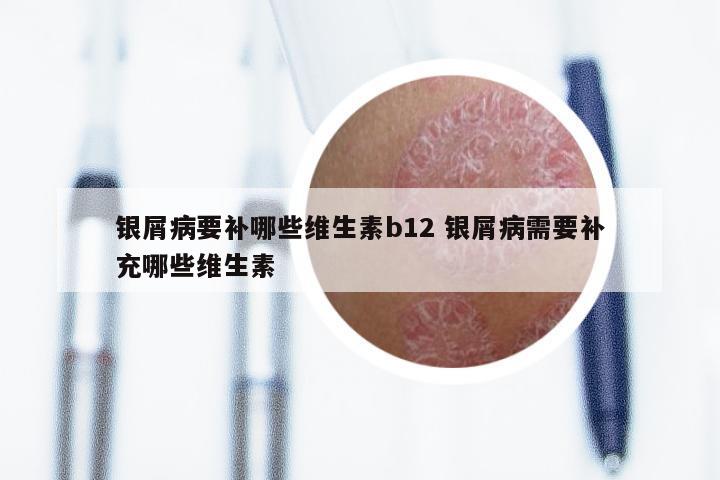 银屑病要补哪些维生素b12 银屑病需要补充哪些维生素