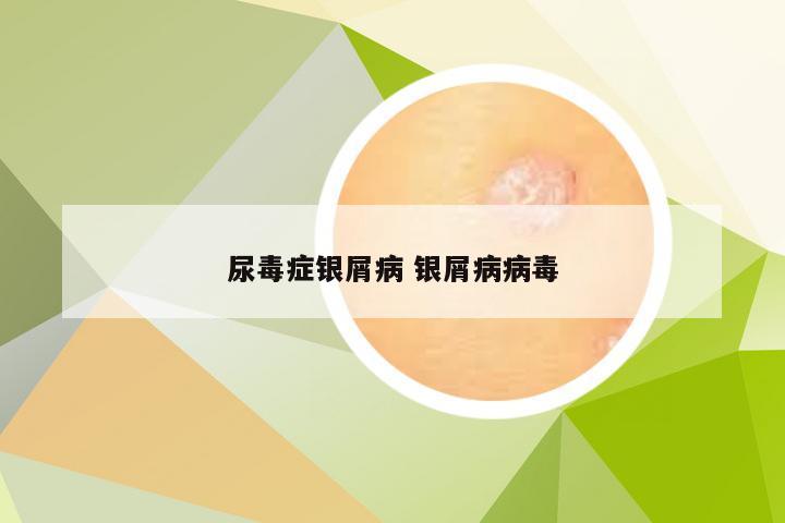 尿毒症银屑病 银屑病病毒