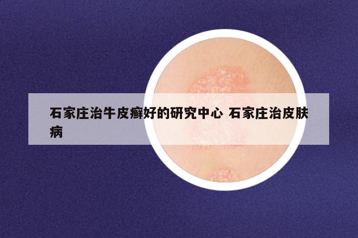 石家庄治牛皮癣好的研究中心 石家庄治皮肤病