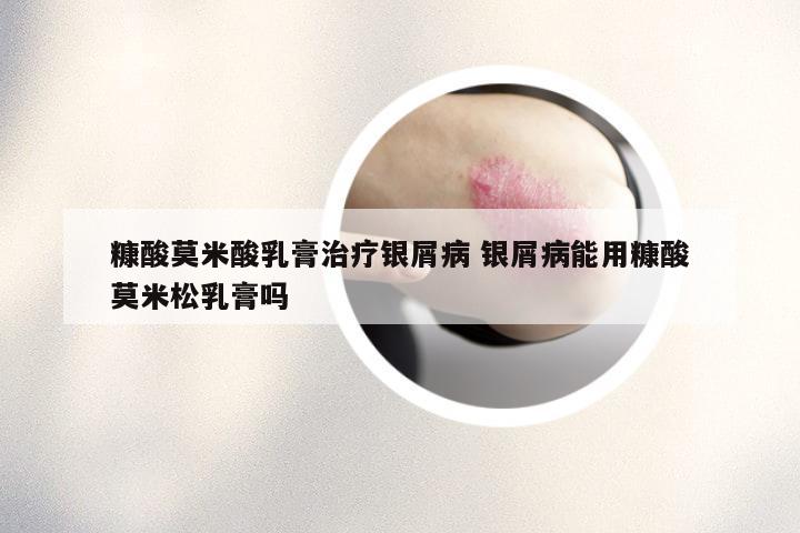 糠酸莫米酸乳膏治疗银屑病 银屑病能用糠酸莫米松乳膏吗