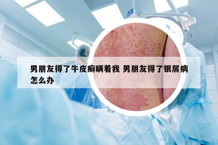 男朋友得了牛皮癣瞒着我 男朋友得了银屑病怎么办