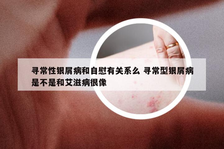 寻常性银屑病和自慰有关系么 寻常型银屑病是不是和艾滋病很像