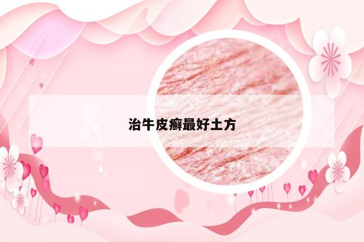 治牛皮癣最好土方
