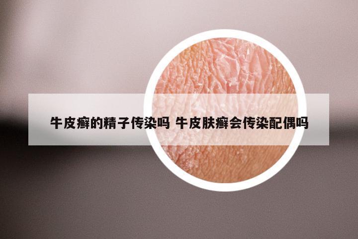 牛皮癣的精子传染吗 牛皮肤癣会传染配偶吗