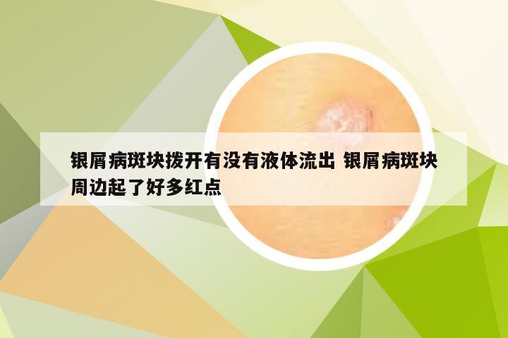 银屑病斑块拨开有没有液体流出 银屑病斑块周边起了好多红点