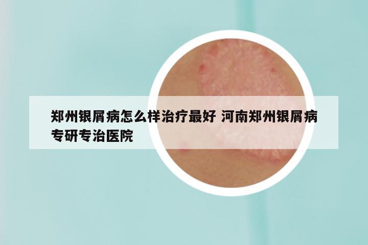 郑州银屑病怎么样治疗最好 河南郑州银屑病专研专治医院