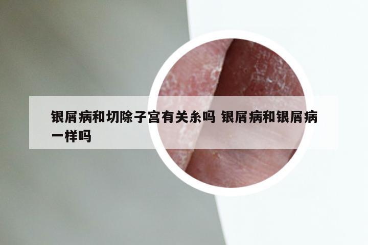 银屑病和切除子宫有关糸吗 银屑病和银屑病一样吗