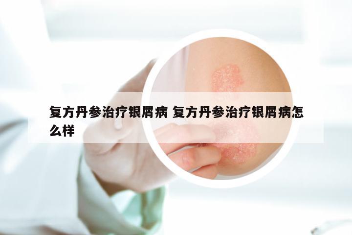 复方丹参治疗银屑病 复方丹参治疗银屑病怎么样