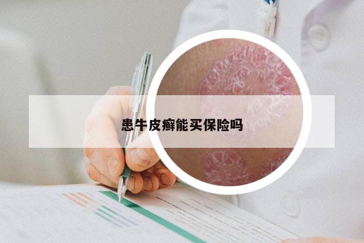 患牛皮癣能买保险吗