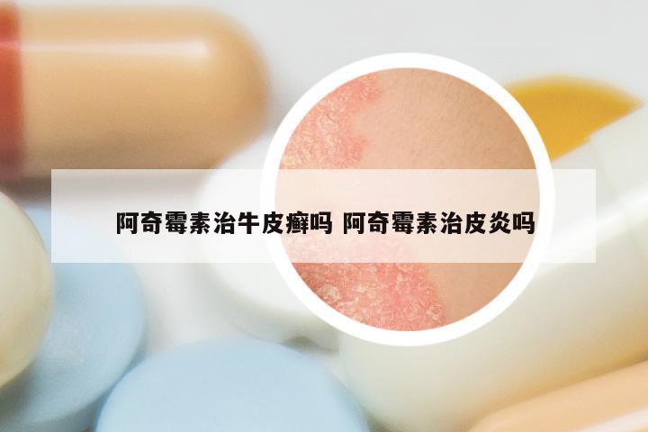 阿奇霉素治牛皮癣吗 阿奇霉素治皮炎吗