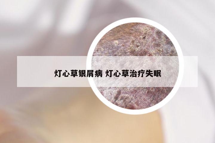 灯心草银屑病 灯心草治疗失眠