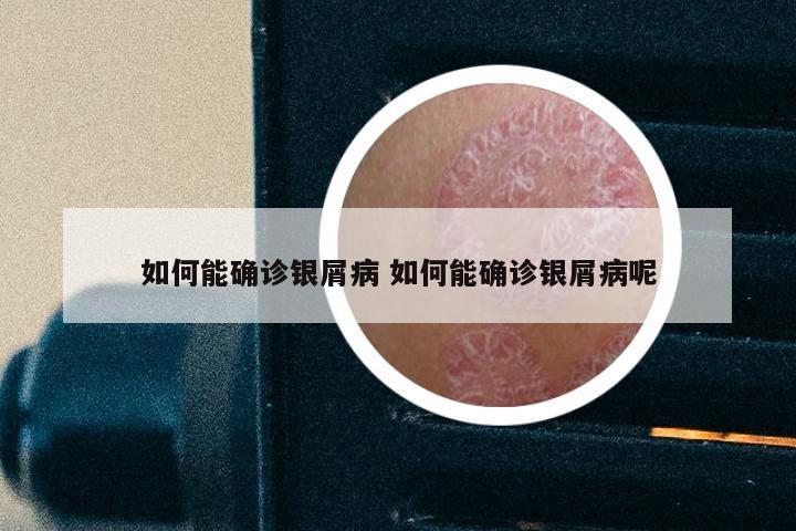 如何能确诊银屑病 如何能确诊银屑病呢