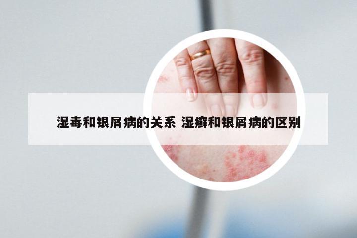 湿毒和银屑病的关系 湿癣和银屑病的区别