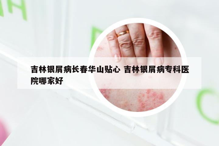 吉林银屑病长春华山贴心 吉林银屑病专科医院哪家好