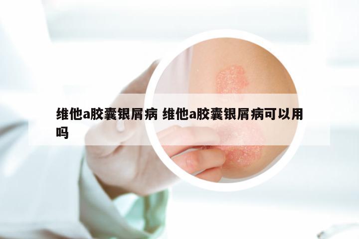 维他a胶囊银屑病 维他a胶囊银屑病可以用吗