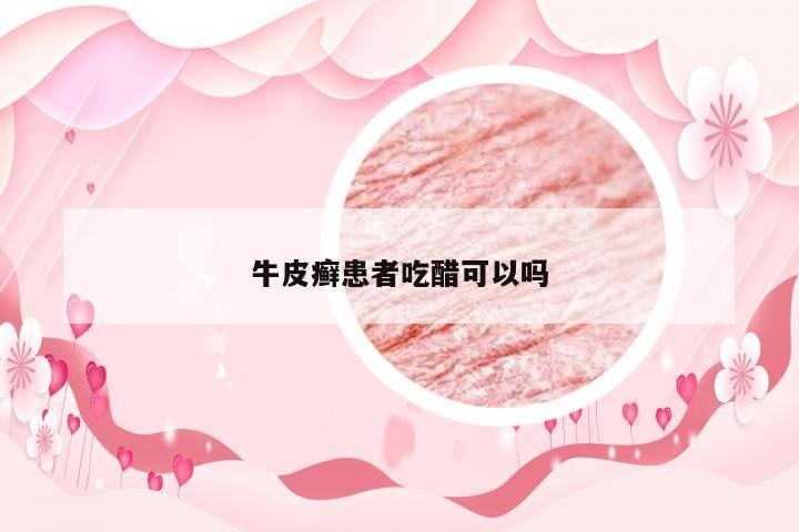 牛皮癣患者吃醋可以吗